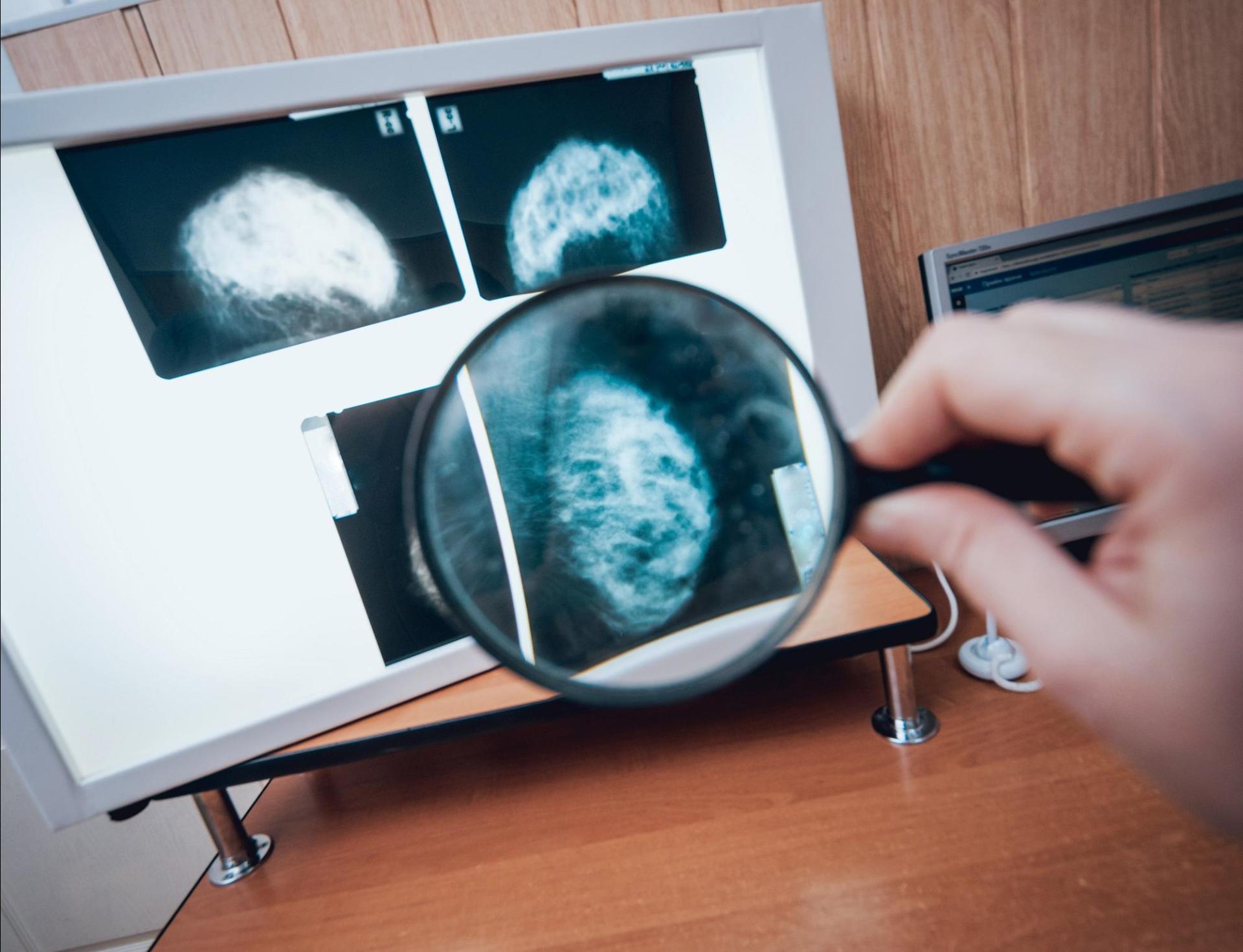 The improvement was consistent across different ages and levels of breast density, which can be risk factors.
