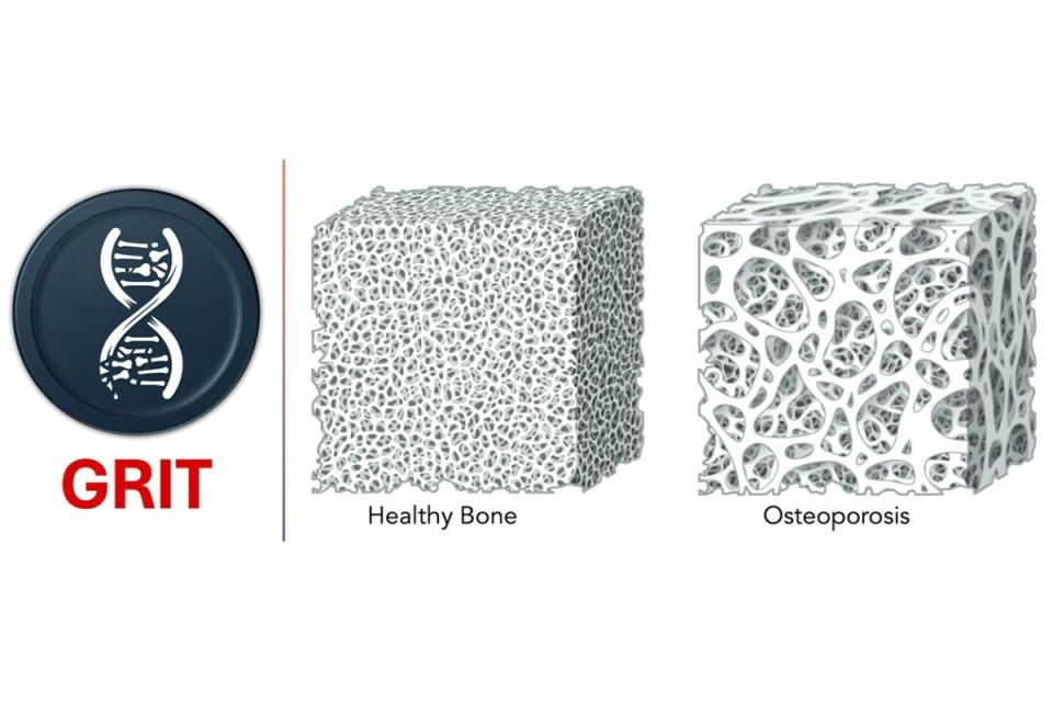 Healthy bone has a honeycomb-like structure whereas osteoporotic bone is more porous, increasing susceptibility to fragility fractures.