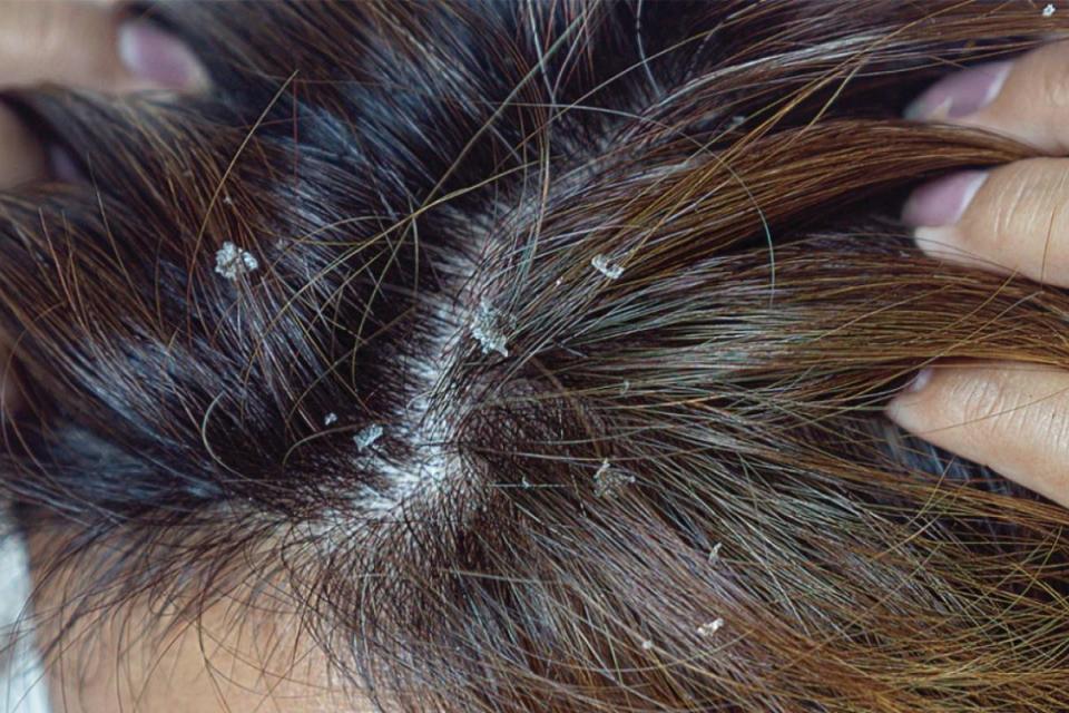 You might find dandruff behind your ears, on the side of your nose and eyebrows.