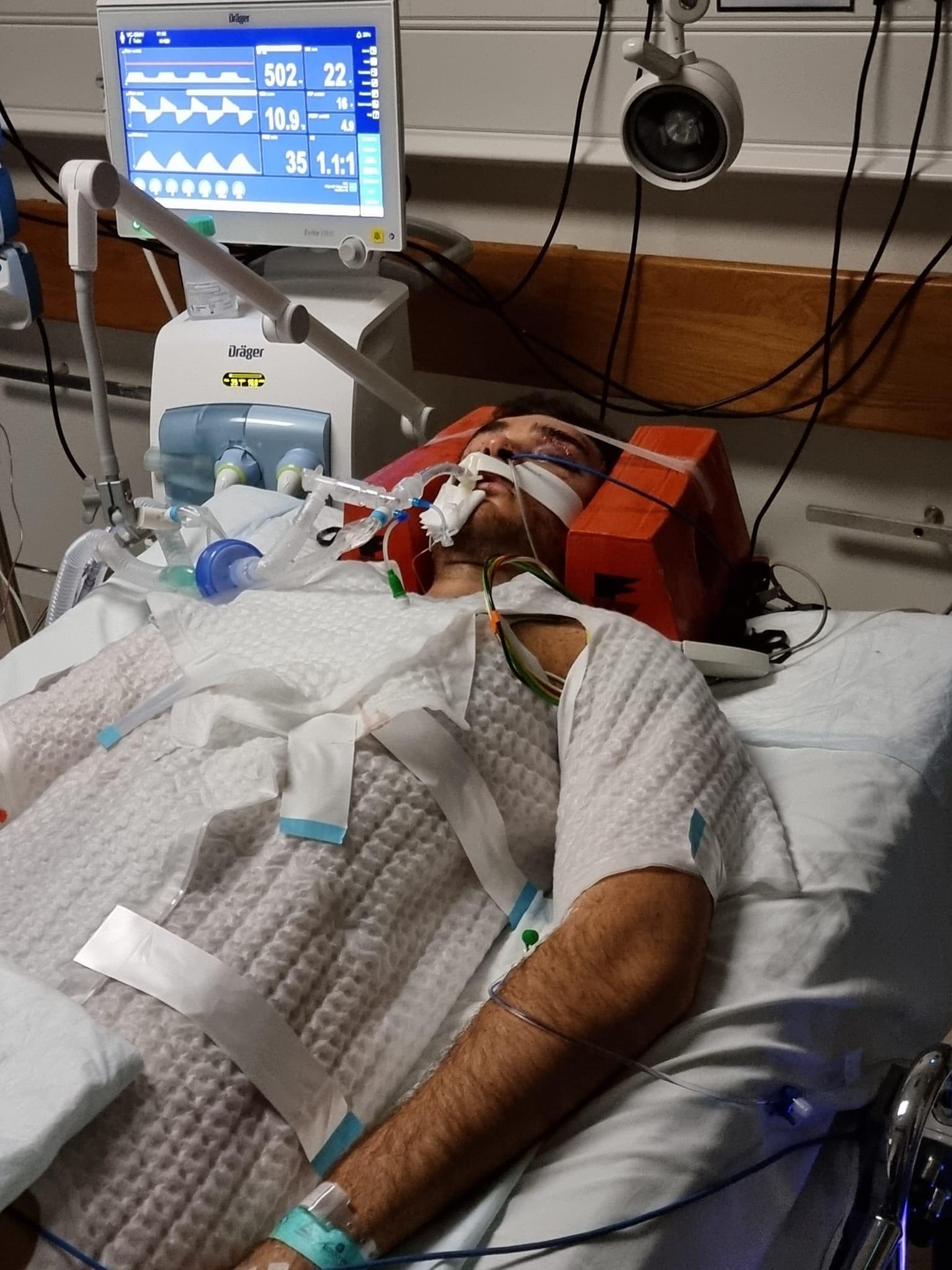 Vincenzo woke from a 10-day coma to discover he had lost his right leg.
