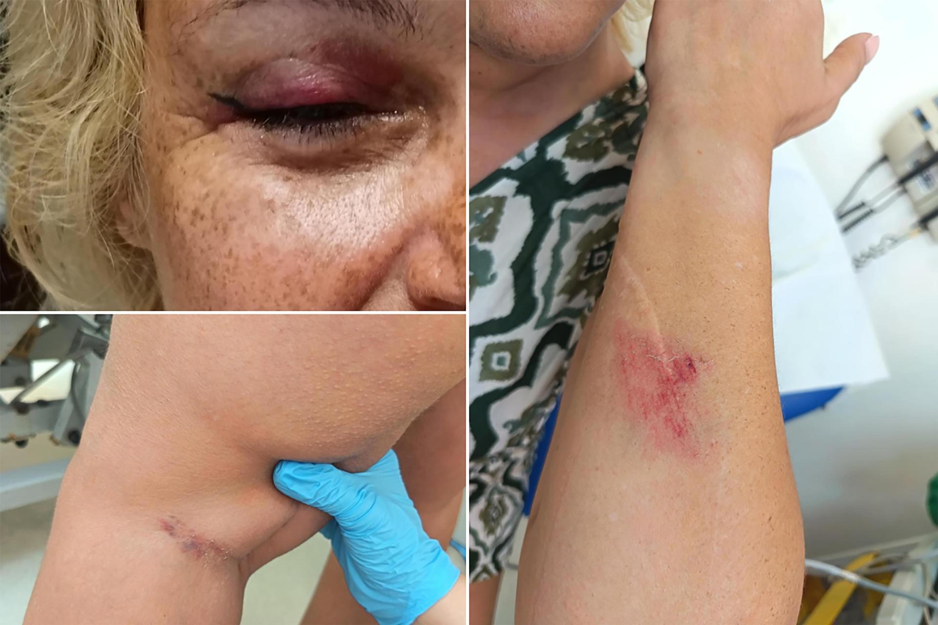 Caroline Magro suffered a black eye, scratches on her face and multiple bruises all over her body.