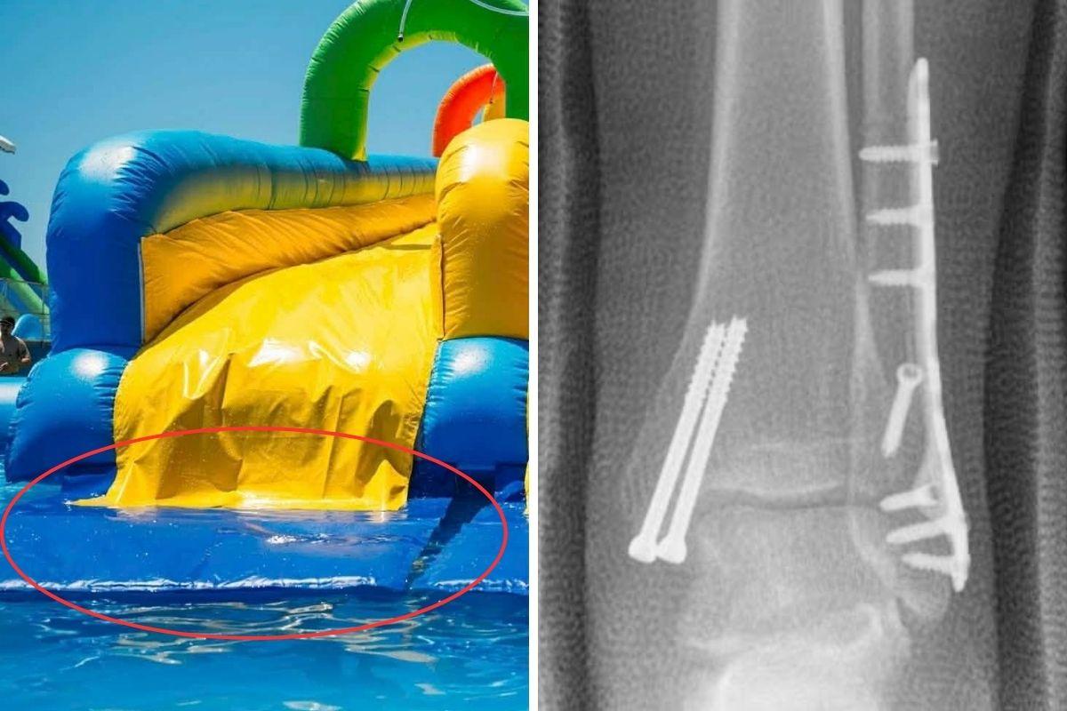 Vella said she required major surgery (right) after crashing into a mat (circled, left) at one of the slides.