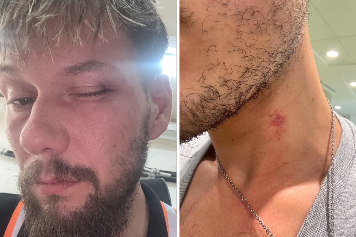 One of the couple was left with a black eye while the other had scratches to his neck. Photo: Kurt Falzon