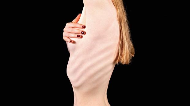 Anorexia sufferers try to keep their weight as low as possible.